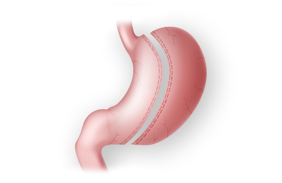 laparoscopic sleeve gastrectomy
